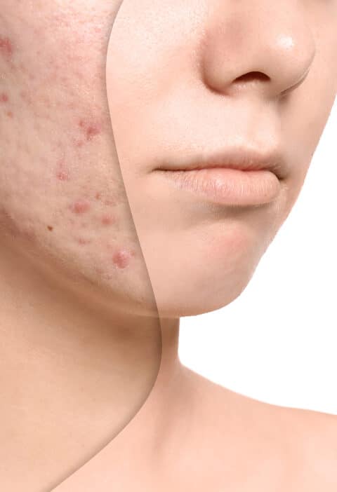 facial treatments acne mobile | Ăn Chay, Thuần Chay, Quán Chay & Nhà Hàng Chay