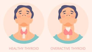 thyroid disease | Ăn Chay, Thuần Chay, Quán Chay & Nhà Hàng Chay