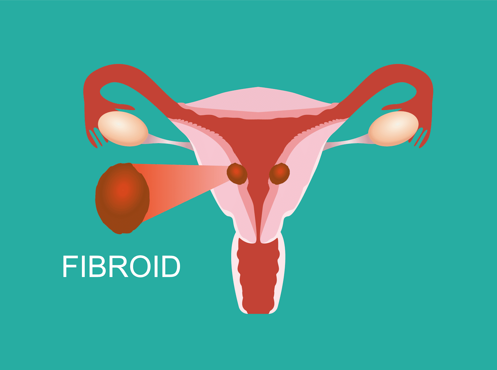 fibroids heavy bleeding | Ăn Chay, Thuần Chay, Quán Chay & Nhà Hàng Chay