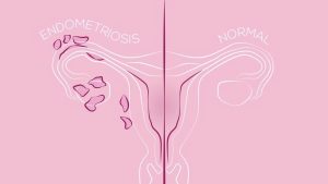 Lạc nội mạc tử cung, ảnh hưởng đến khoảng 190 triệu phụ nữ và trẻ em gái trong độ tuổi sinh sản trên toàn cầu, được đặc trưng bởi sự hiện diện của các mô nội mạc tử cung bên ngoài niêm mạc tử cung, điển hình là ở bề mặt bên ngoài tử cung, buồng trứng, ống dẫn trứng, thành bụng hoặc ruột.